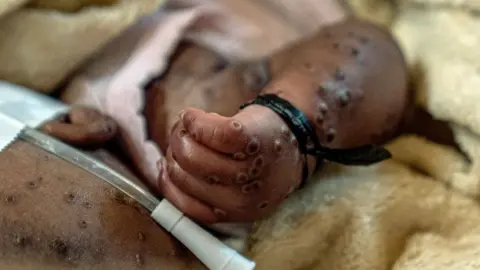 Glody Murhabazi The arm of a baby with mpox blisters in Lwiro hospital, DR Congo